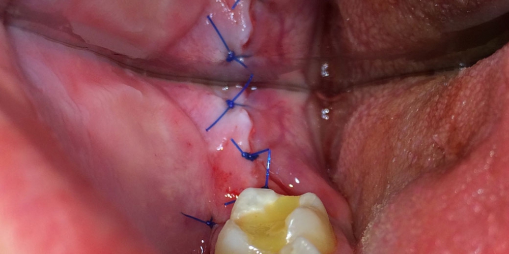 Удаление зуба мудрости: насколько больно, как проходит операция?