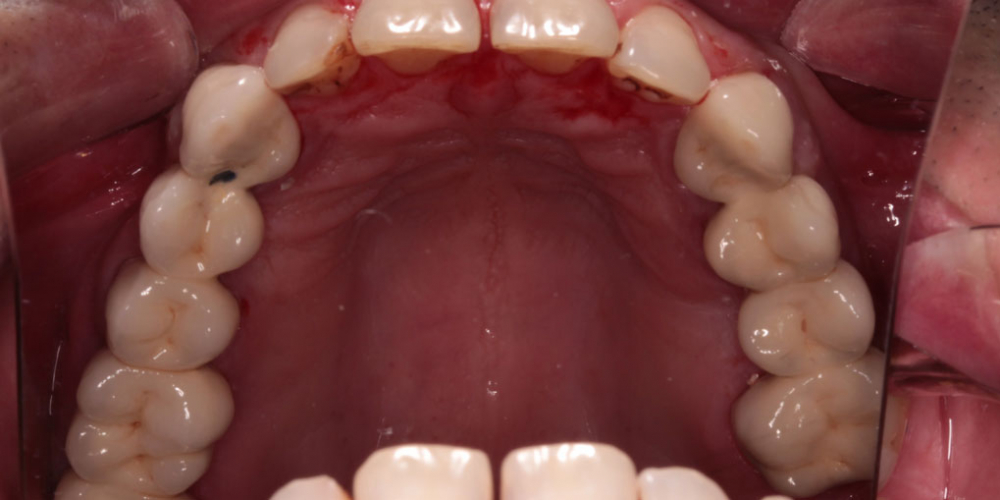  Протезирование верхнего зубного ряда металлокерамическими коронками
