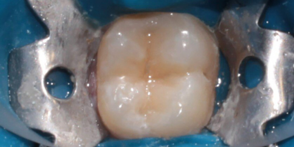  Лечение глубокого кариеса жевательного зуба 3.6
