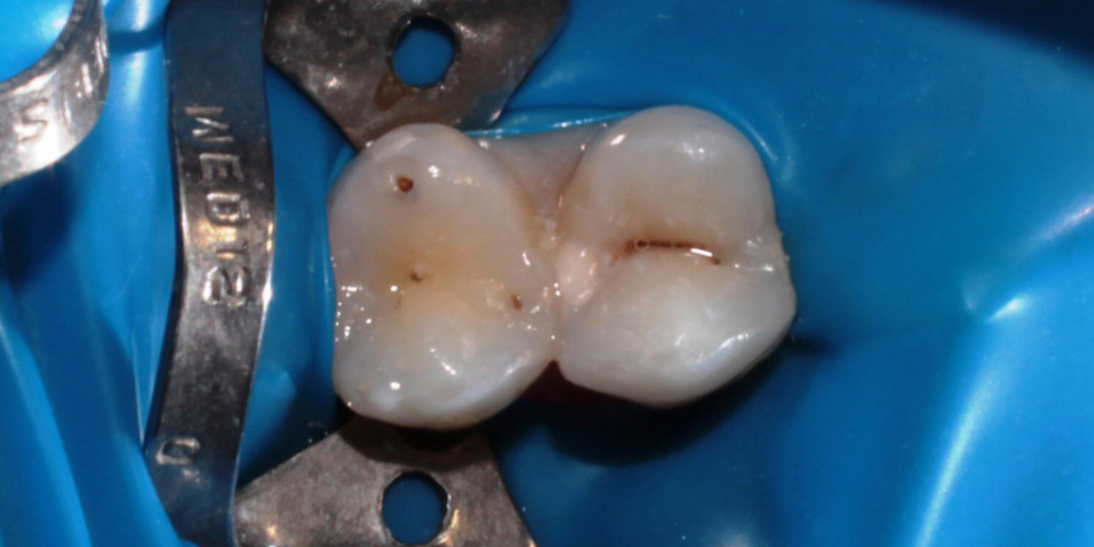  Лечение глубокого кариеса зуба 1.4 (верхний первый премоляр справа)