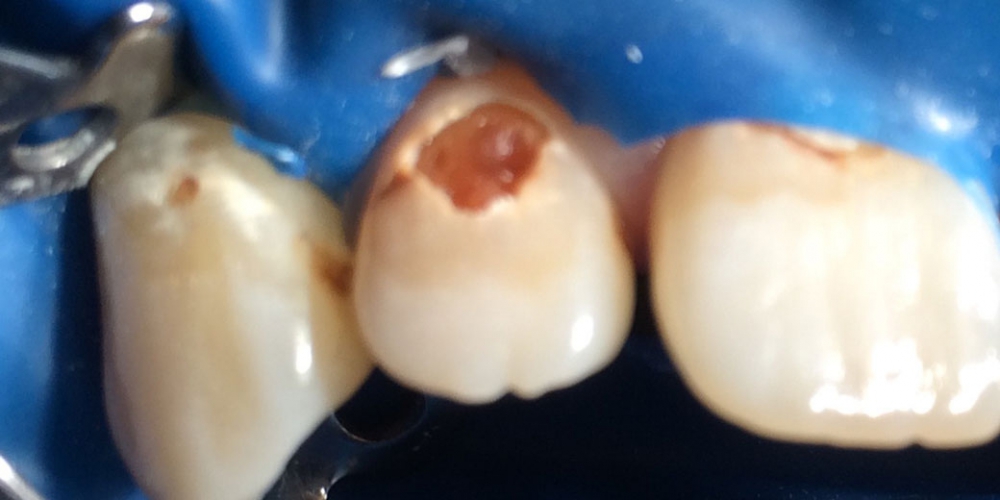 Фото до лечения. Результат лечения глубокого кариеса переднего зуба