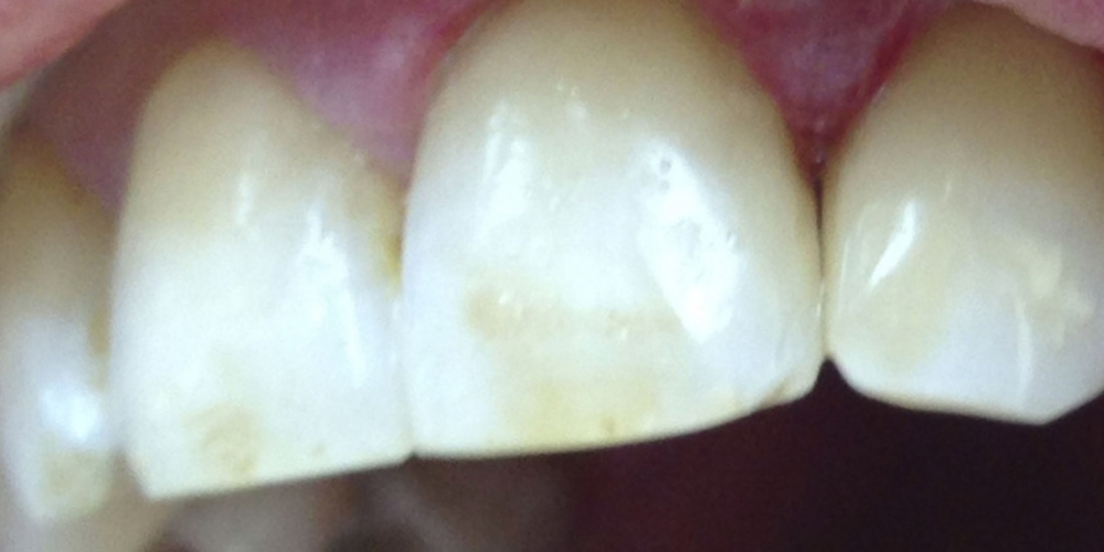  Лечение кариеса переднего зуба