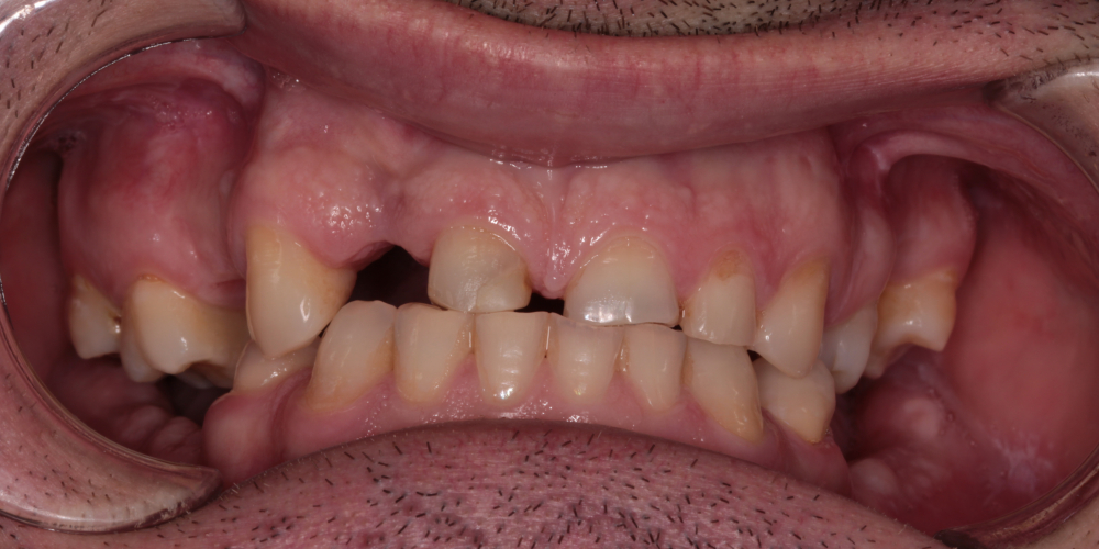  Тотальная реабилитация зубных рядов, фото до и после