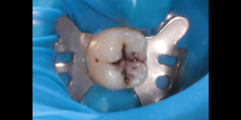 Вылечил глубокий кариес зуба 4.6 фото до лечения