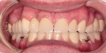 Тотальная реабилитация зубных рядов, фото до и после фото после лечения