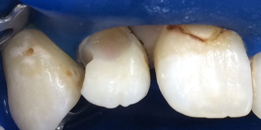 Фото в процессе лечения. Результат лечения глубокого кариеса переднего зуба