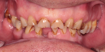 Тотальная реабилитация зубных рядов металлокерамическими коронками + бюгельные протезы фото до лечения
