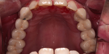 Протезирование верхнего зубного ряда металлокерамическими коронками фото после лечения