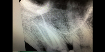 Депульпирование 4х канального жевательного зуба фото после лечения