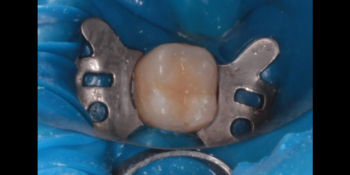 Вылечил глубокий кариес зуба 4.6 фото после лечения