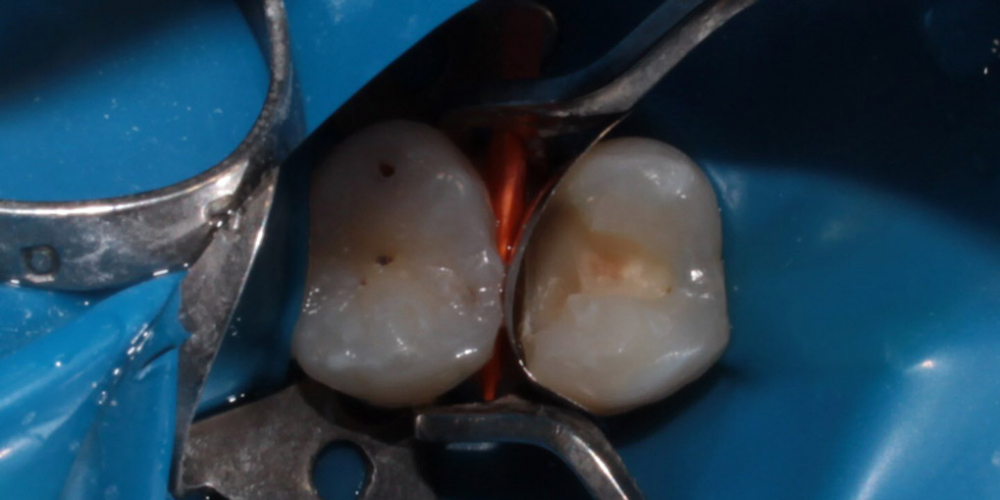  Лечение глубокого кариеса зуба 1.4 (верхний первый премоляр справа)