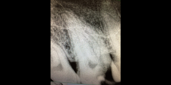 Депульпирование 4х канального жевательного зуба фото до лечения