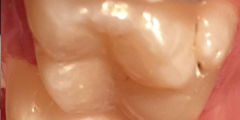 Лечение кариеса и реставрация зуба фото после лечения