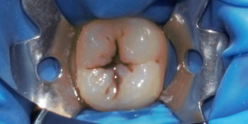 Лечение глубокого кариеса жевательного зуба 3.6 фото до лечения