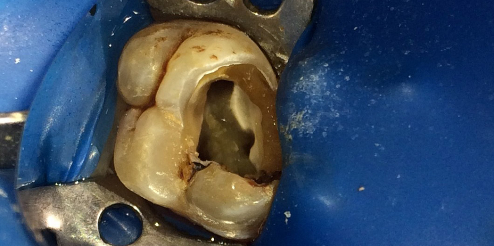  Депульпирование 4х канального жевательного зуба