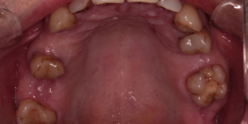 Протезирование верхнего зубного ряда металлокерамическими коронками фото до лечения