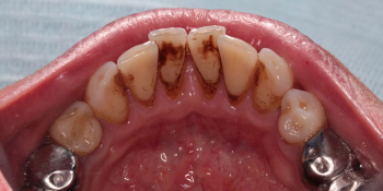 Профессиональная чистка зубов на нижней челюсти фото до лечения