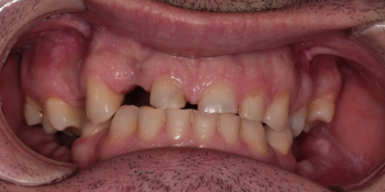 Тотальная реабилитация зубных рядов, фото до и после фото до лечения